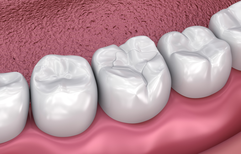 3D illustration of molars with dental sealants applied to their chewing surfaces