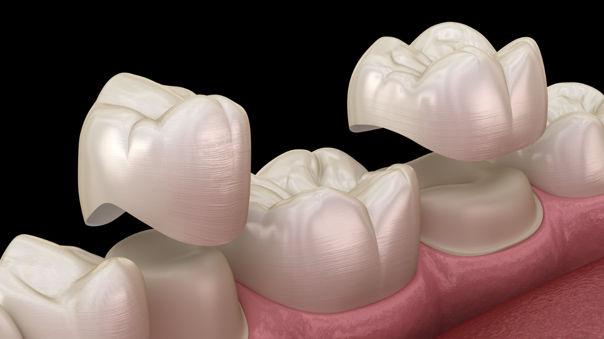 3D illustration of porcelain dental crowns being placed over prepared teeth